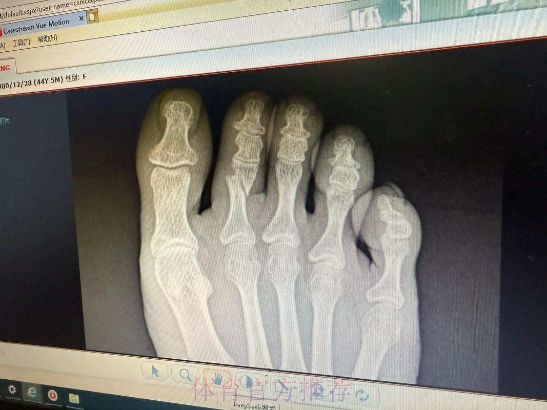 皇马官方:琼阿梅尼左脚第二跖骨不完全应力性骨折 皇马官方:琼阿梅尼左脚第二跖骨不完全应力性骨折